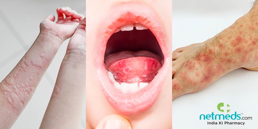 Skin issues that could be a sign of coronavirus