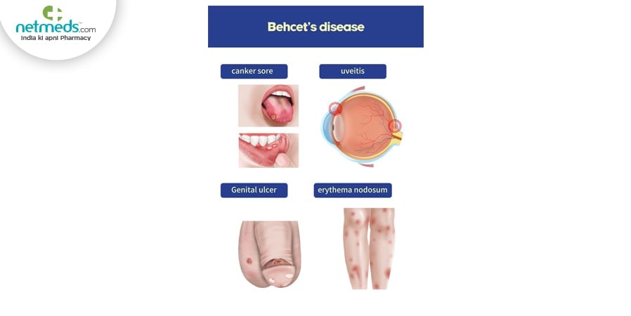 Bechet's Disease