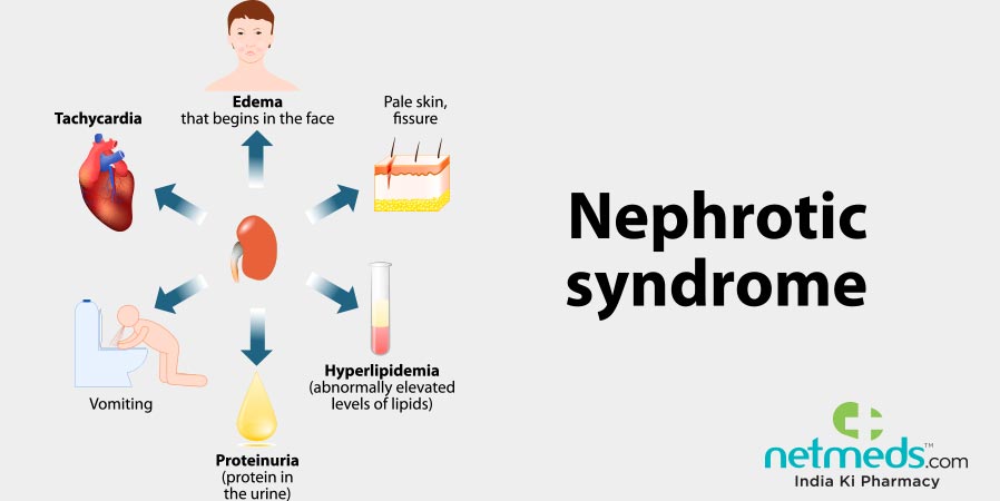 Nephrotic Syndrome