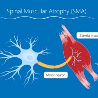 Spinal Muscular Atrophy: Causes, Symptoms Of This Genetic Disorder With World's Most Expensive Drug