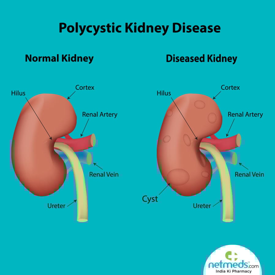 Polycystic kidney disease