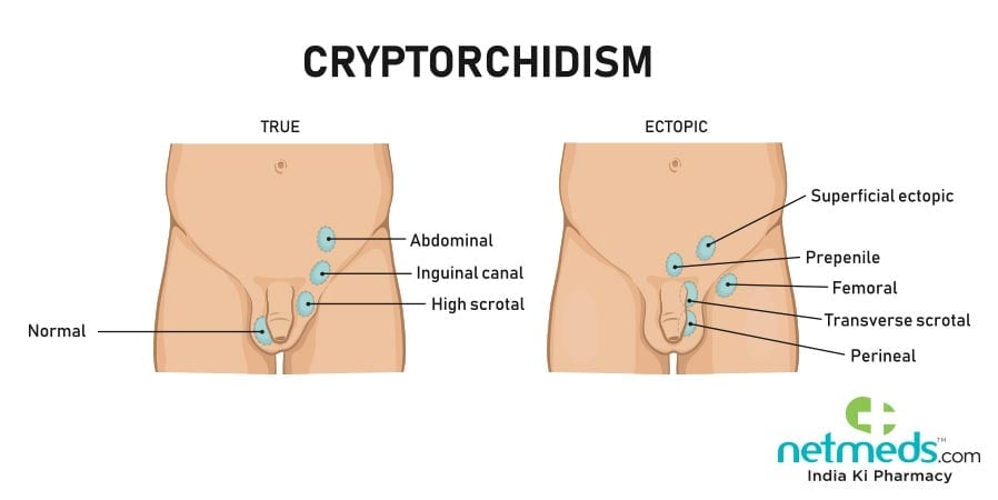 Causes, Symptoms And Treatment Of Cryptorchidism