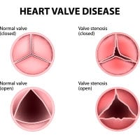 Heart Valve Disease: Causes, Symptoms And Treatment