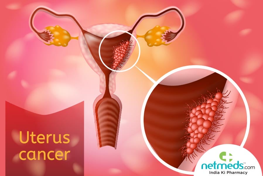 uterine cancer