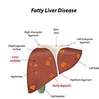 Fatty Liver: Causes, Symptoms And Treatment