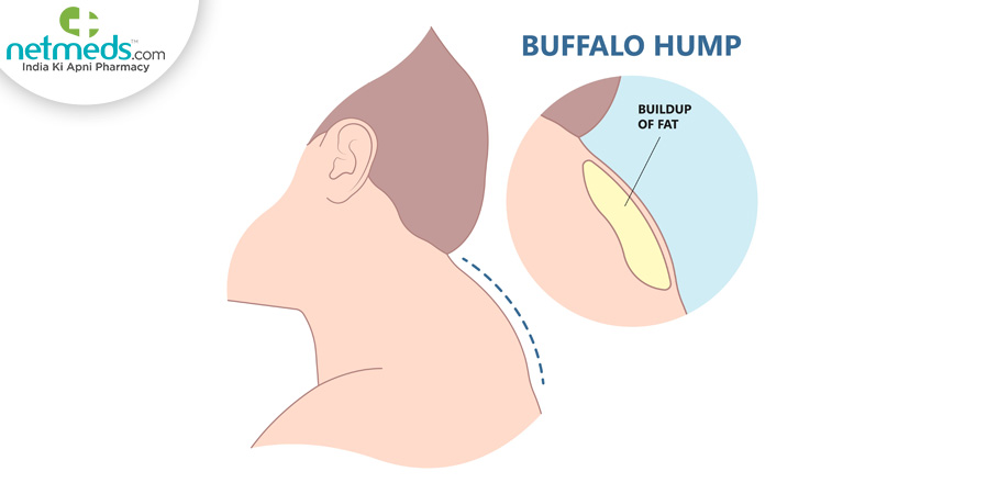 Buffalo Hump