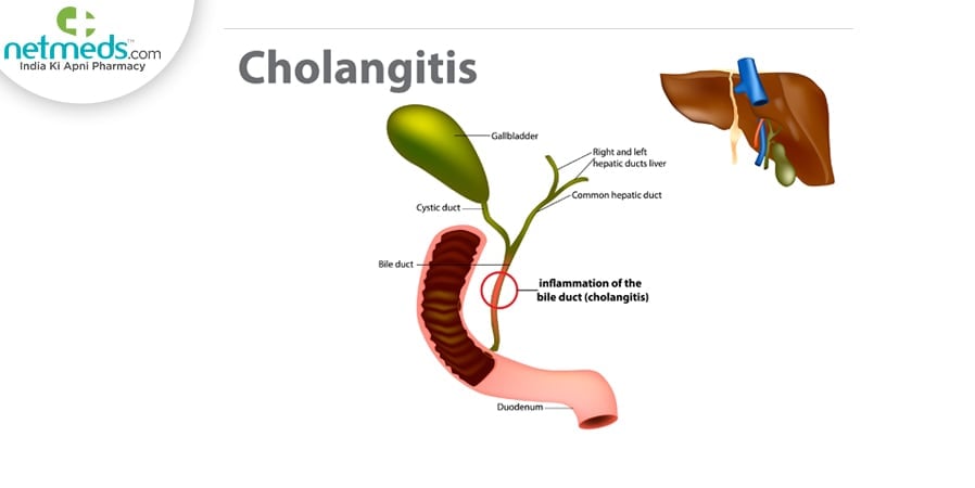 Cholangitis