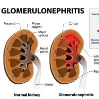 Glomerulonephritis: Causes, Symptoms and Treatment