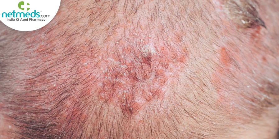 scalp acne