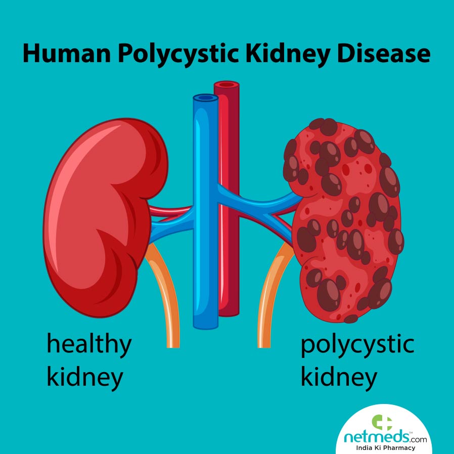 Human Polycystic Kidney Disease