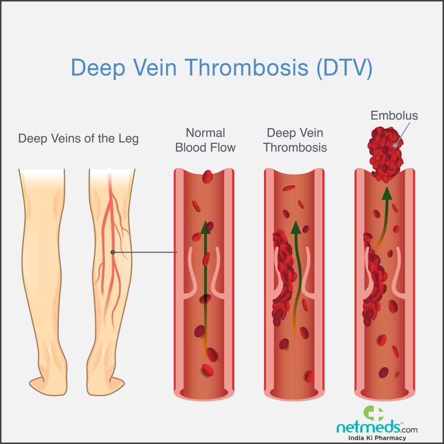 Deep Vein Thrombosis