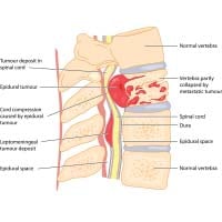 Spinal Cord Tumour: Causes, Symptoms And Treatment