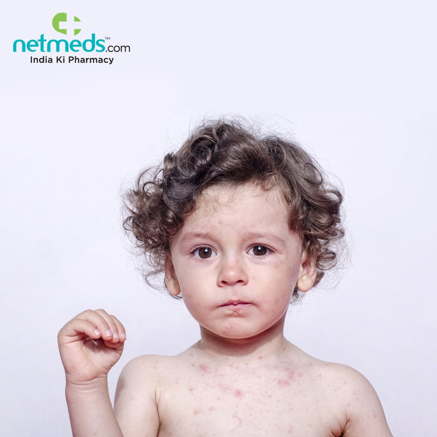 Atopic Dermatitis affects kids at an early age