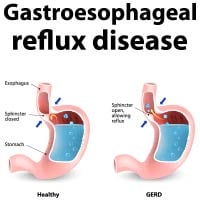 GERD: Symptoms, Causes, Stages, And Treatment