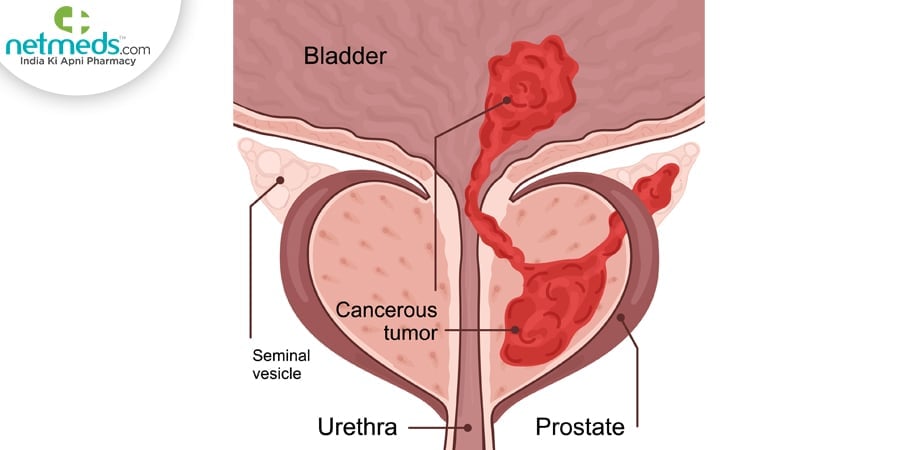 Seminal vesicle cancer