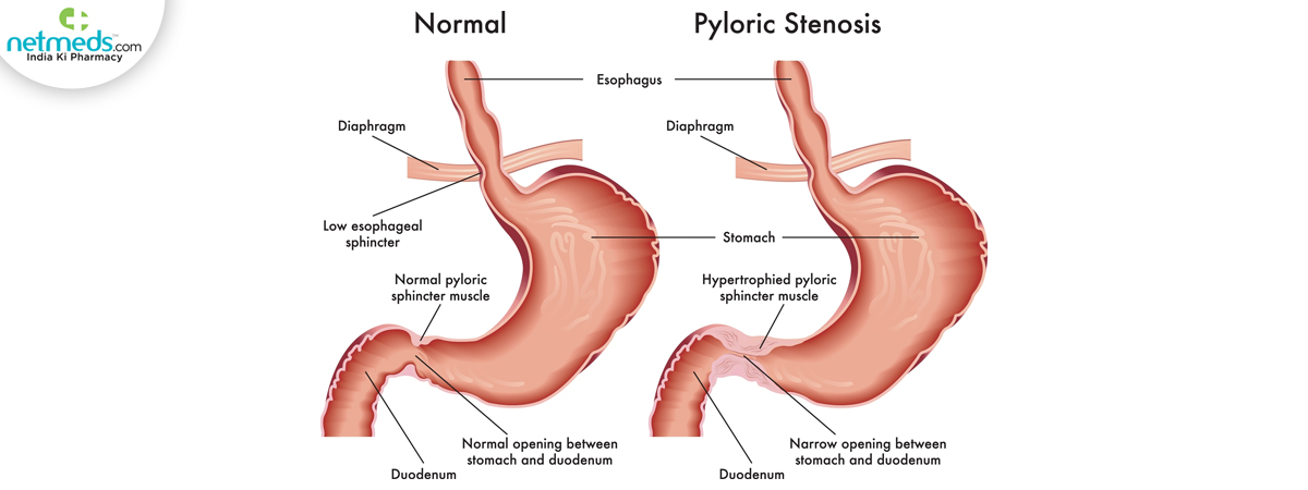 pyloric stenosis