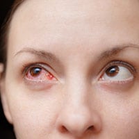 COVID-19 And Conjunctivitis: Understanding How Coronavirus Infection Induces Pink Eye
