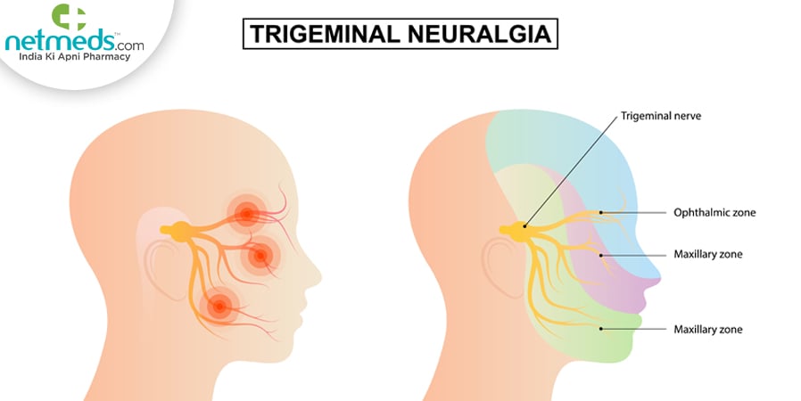 Trigeminal neuralgia