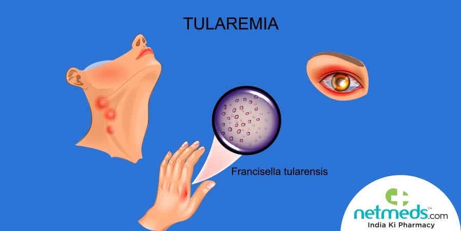 Causes, Symptoms and Treatment of Tularemia
