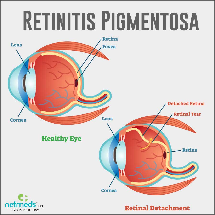 retinitis pigmentosa causes
