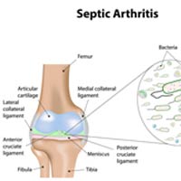 Septic Arthritis: Causes, Symptoms And Treatment