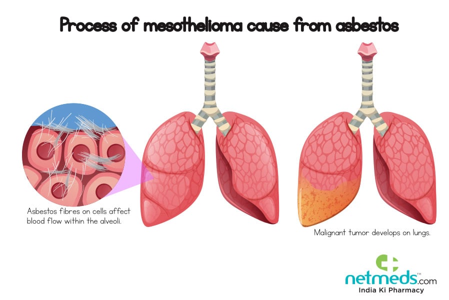 mesothelioma