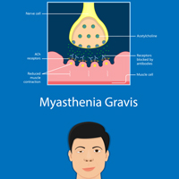 Myasthenia Gravis: Causes, Symptoms And Treatment Of This Autoimmune Disorder