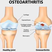 Osteoarthritis: Causes, Symptoms And Treatment