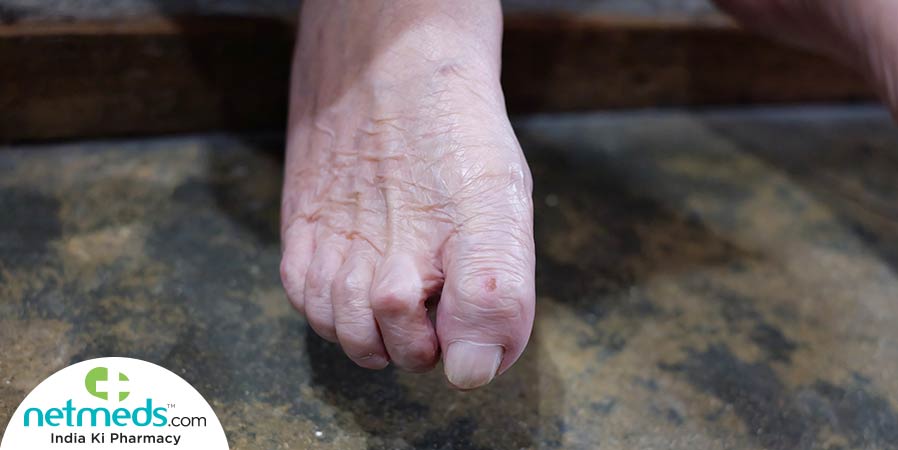 Claw toe