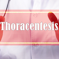 Thoracentesis: Purpose, Benefits, Results And Risks Of This Pleural Fluid Sampling Test