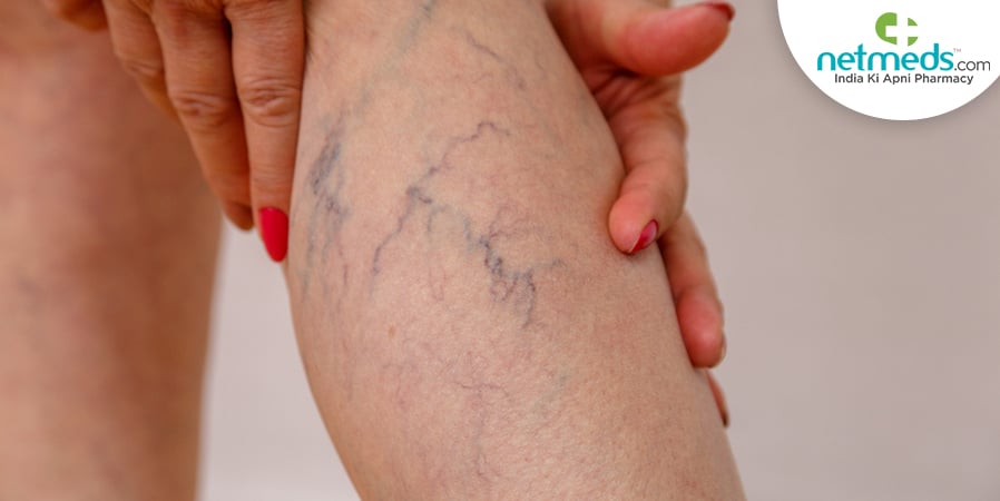 Telangiectasias/Spider Veins