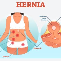 Hernia: Causes, Symptoms And Treatment