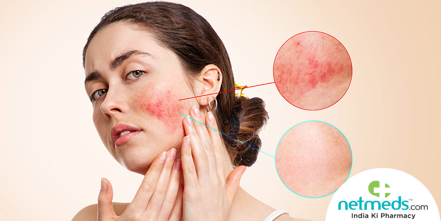 Rosacea