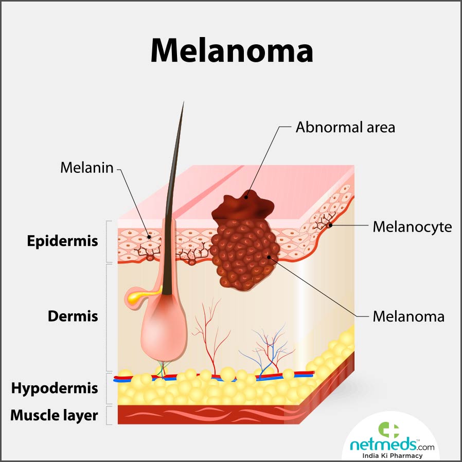 melanoma