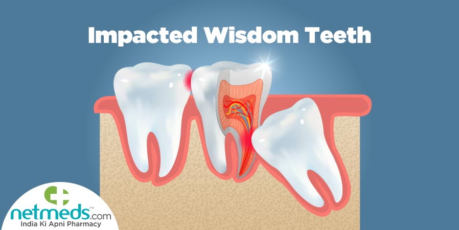 Impacted wisdom teeth