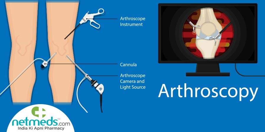 Arthroscopy