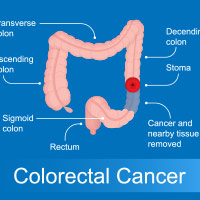 Rectal Cancer: Causes, Symptoms And Treatment