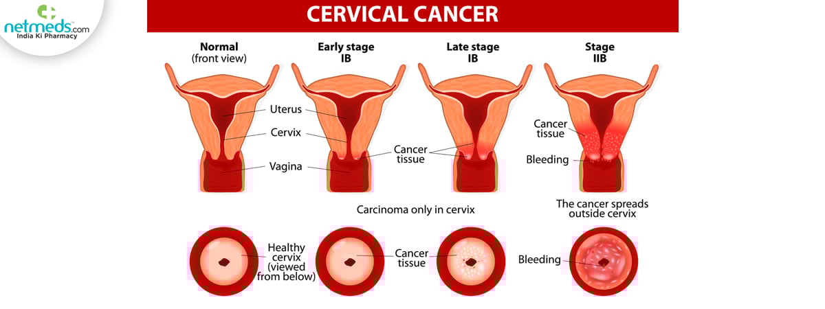 Cervical-cancer_1200x450
