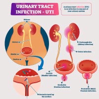 Urinary Tract Infection (UTI): Causes, Symptoms And Treatment