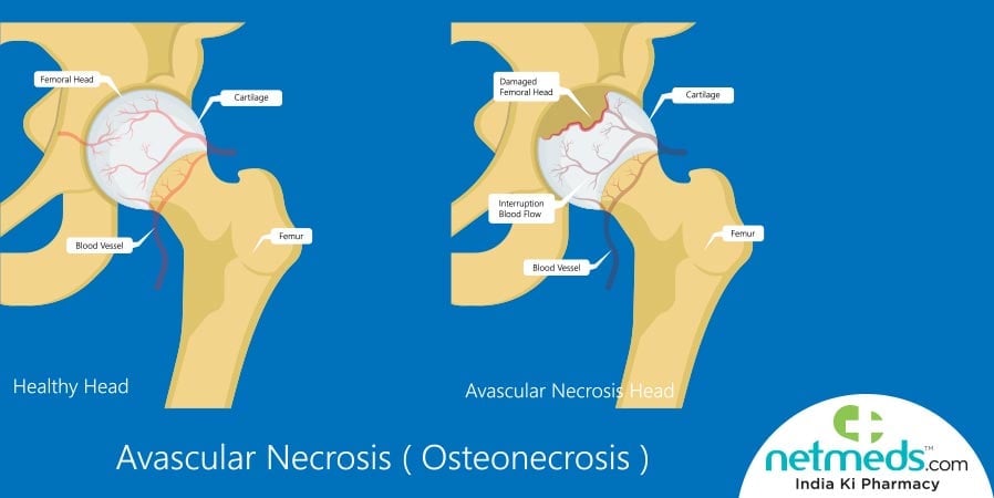 Avascular Necrosis