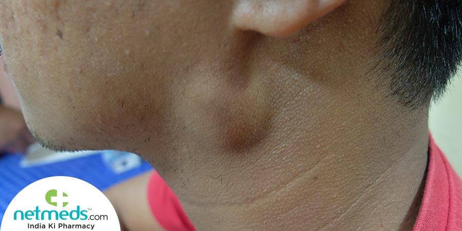 Cystic Hygroma