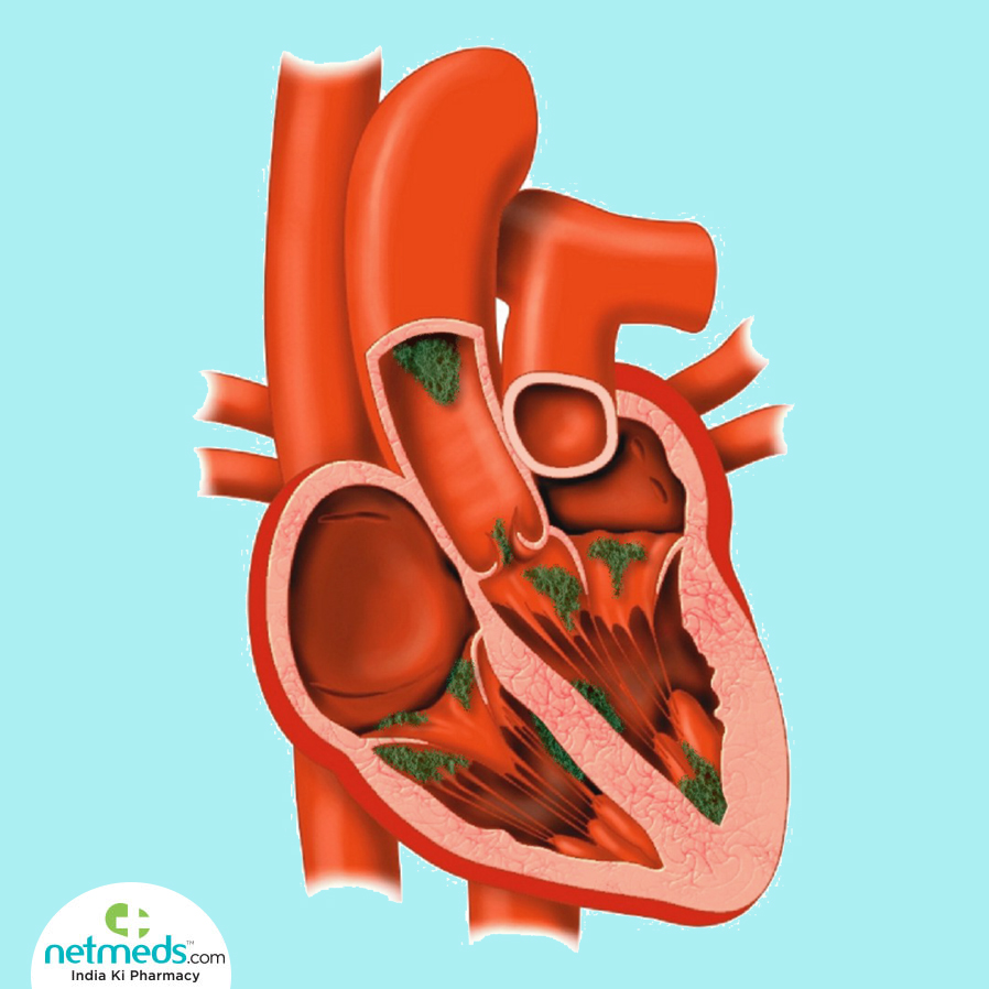 Endocarditis