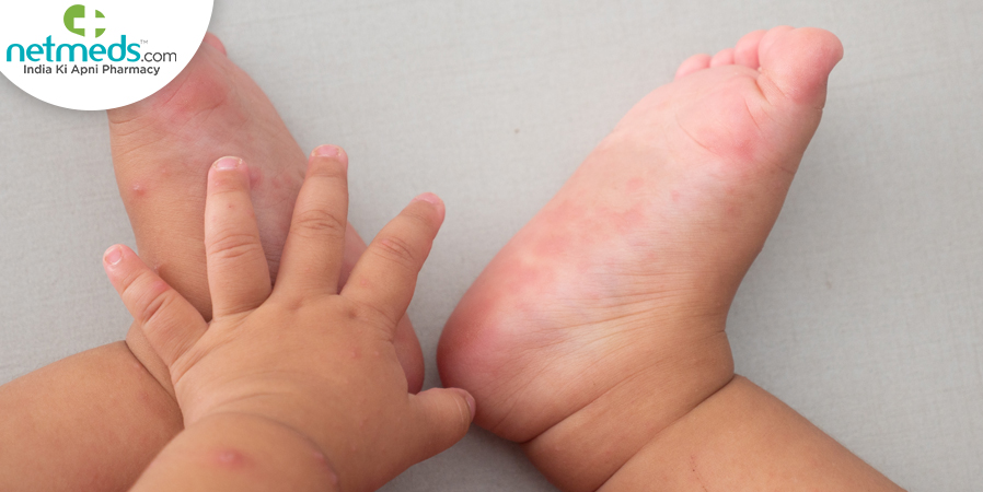 child with hand foot mouth disease