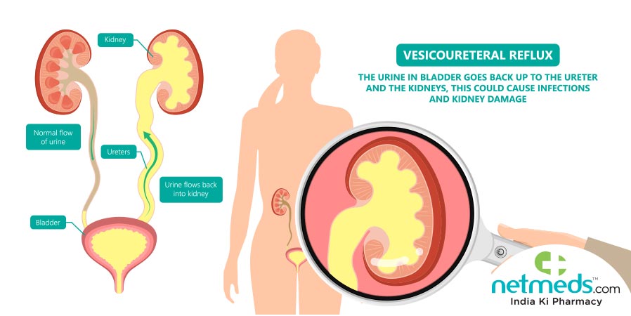 Vesicoureteral reflux