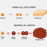 Carcinoid Tumours: Causes, Symptoms And Treatment