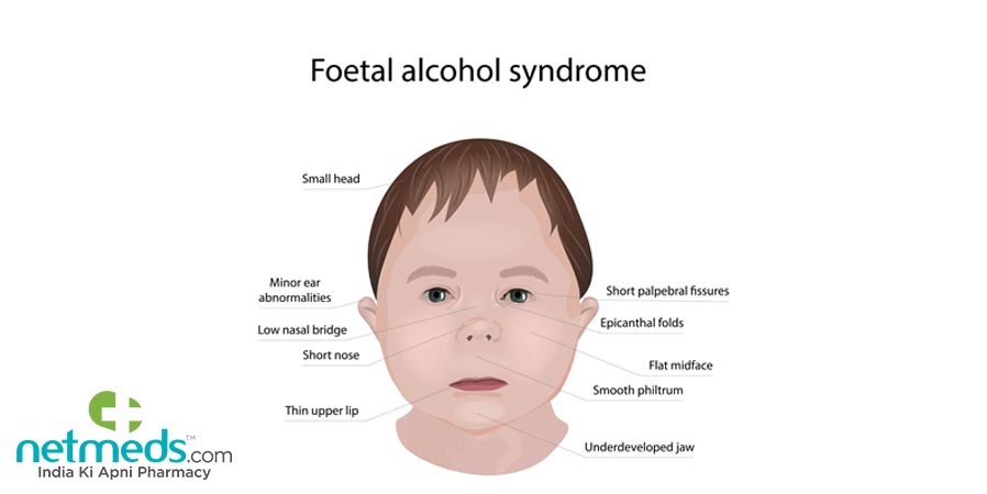 Foetal alcohol syndrome