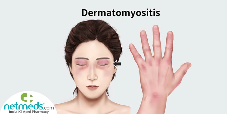 Dermatomyositis