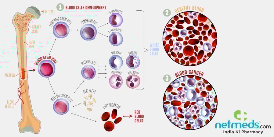 Hairy Cell Leukemia