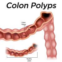 Colon Polyps: Symptoms, Causes And Treatment