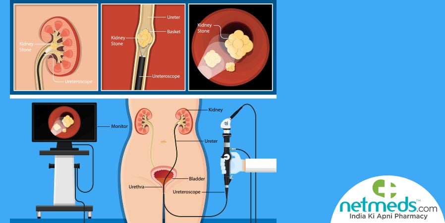 Ureteroscopy